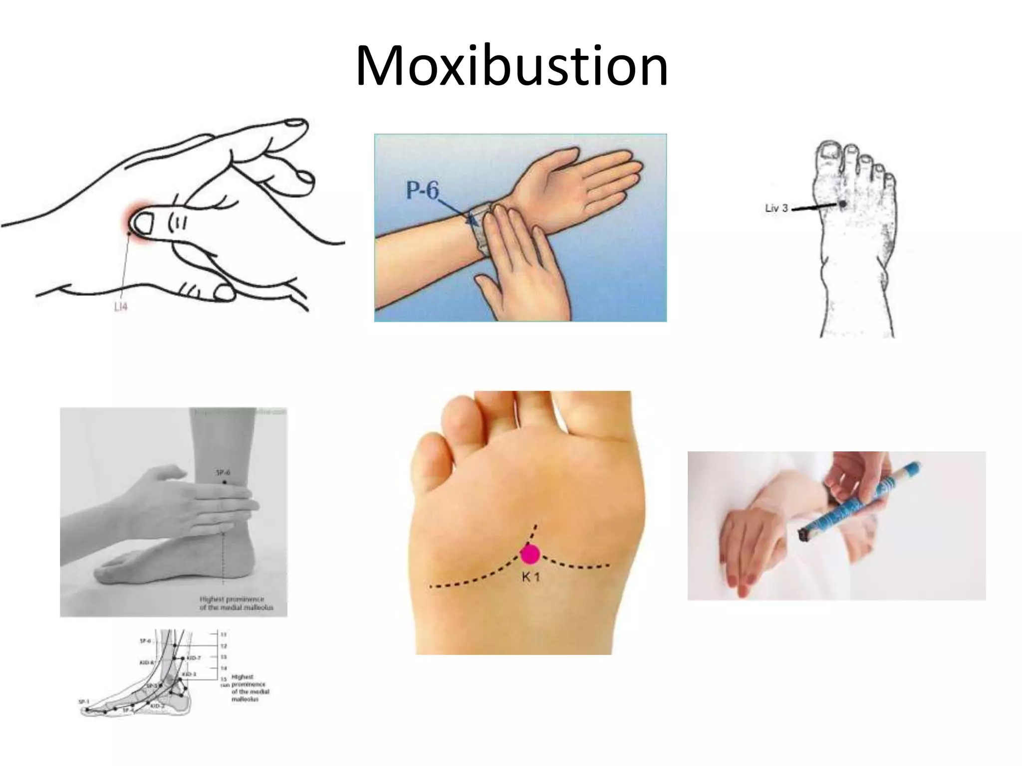 Moxibustion
 