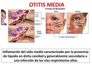 OTITIS MEDIA 
Inflamación del oído medio caracterizado por la presencia 
de líquido en dicha cavidad y generalmente secundaria a 
una infección de las vías respiratorias altas 
 