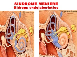 SINDROME MENIERE 
Hidrops endolaberintico 
 
