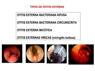 TIPOS DE OTITIS EXTERNA 
OTITIS EXTERNA BACTERIANA DIFUSA 
OTITIS EXTERNA BACTERIANA CIRCUNSCRITA 
OTITIS EXTERNA MICÓTICA 
OTITIS EXTERNAS VÍRICAS (miringitis bullosa) 
 