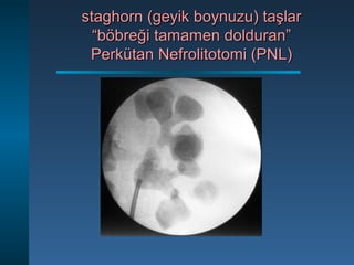 staghorn (geyik boynuzu) taşlarstaghorn (geyik boynuzu) taşlar
“böbreği tamamen dolduran”“böbreği tamamen dolduran”
Perkütan Nefrolitotomi (PNL)Perkütan Nefrolitotomi (PNL)
 