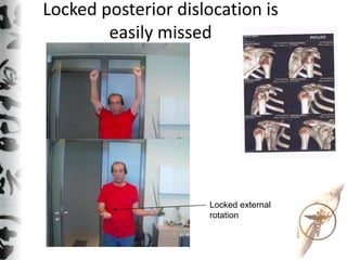 Locked posterior dislocation is
easily missed
Locked external
rotation
 