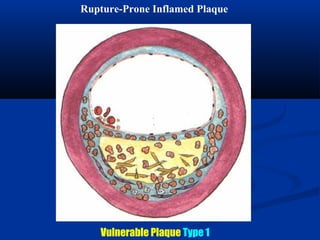 Rupture-Prone Inflamed Plaque
Vulnerable Plaque Type 1
 