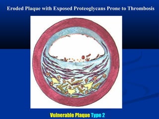 Eroded Plaque with Exposed Proteoglycans Prone to Thrombosis
Vulnerable Plaque Type 2
 