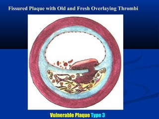 Fissured Plaque with Old and Fresh Overlaying Thrombi
Vulnerable Plaque Type 3
 