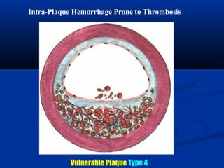 Intra-Plaque Hemorrhage Prone to Thrombosis
Vulnerable Plaque Type 4
 