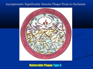 Vulnerable Plaque Type 5
Asymptomatic Significantly Stenotic Plaque Prone to Occlusion
 