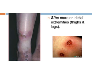  Site: more on distal
extremities (thighs &
legs).