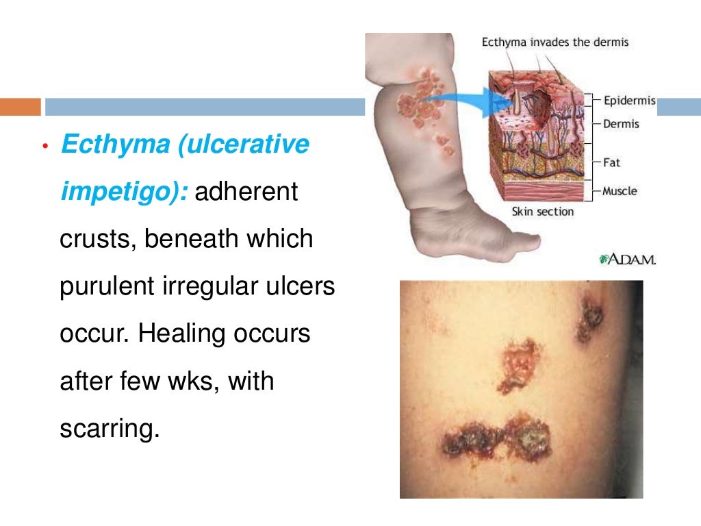Ecthyma Ecthyma