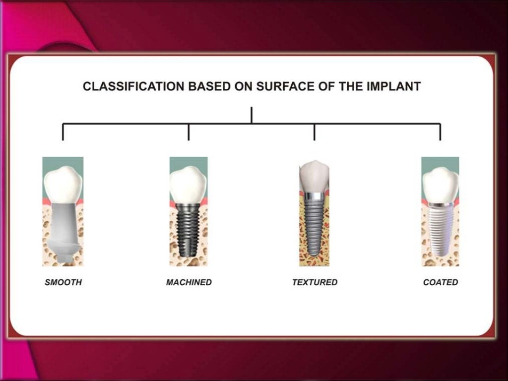 types and classification of dental implants