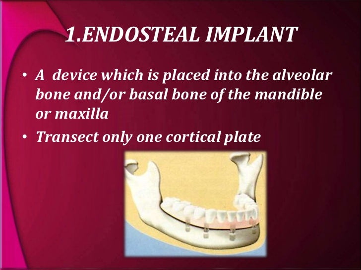 types and classification of dental implants endosteal implant