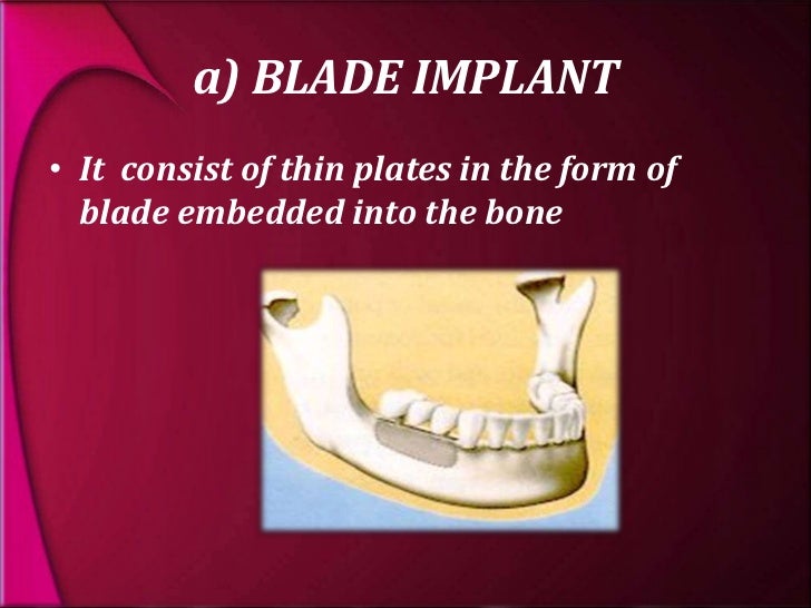 types and classification of dental implants