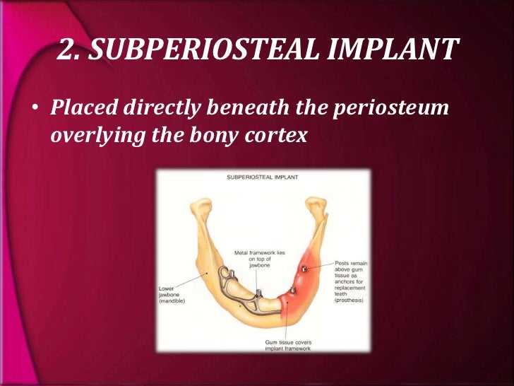 types and classification of dental implants