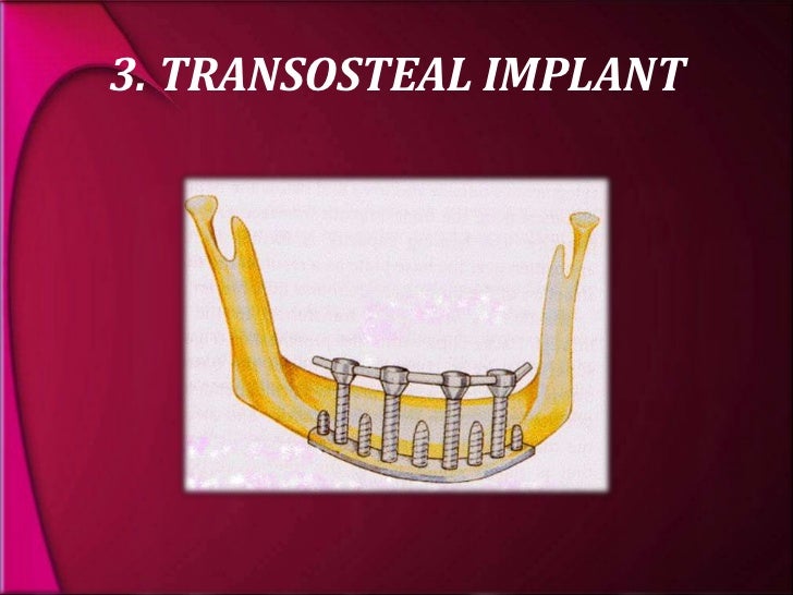 types and classification of dental implants