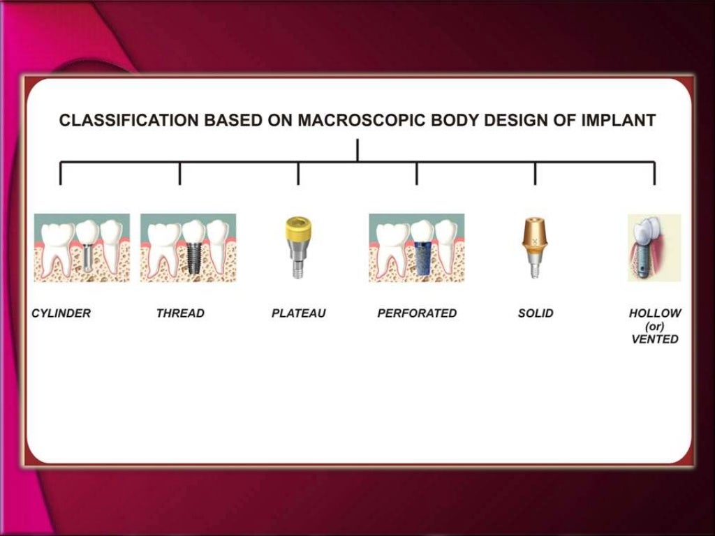 types and classification of dental implants