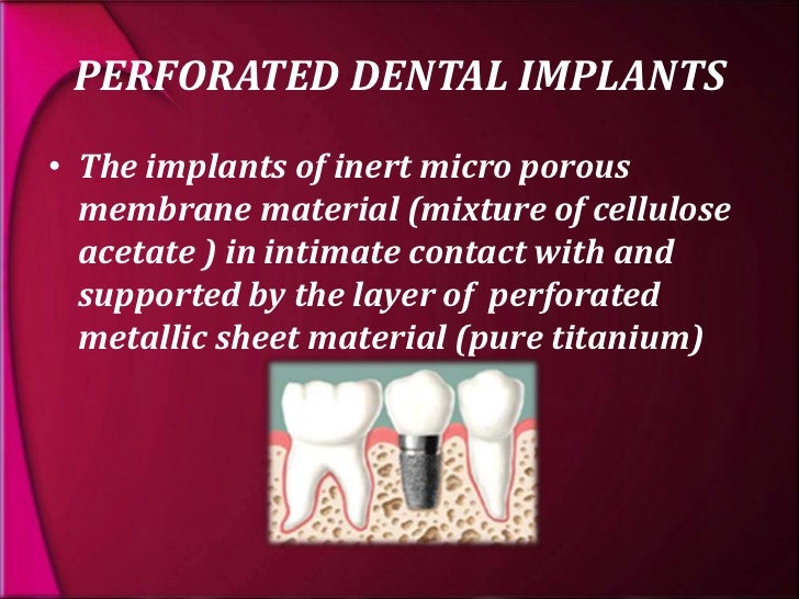 types and classification of dental implants