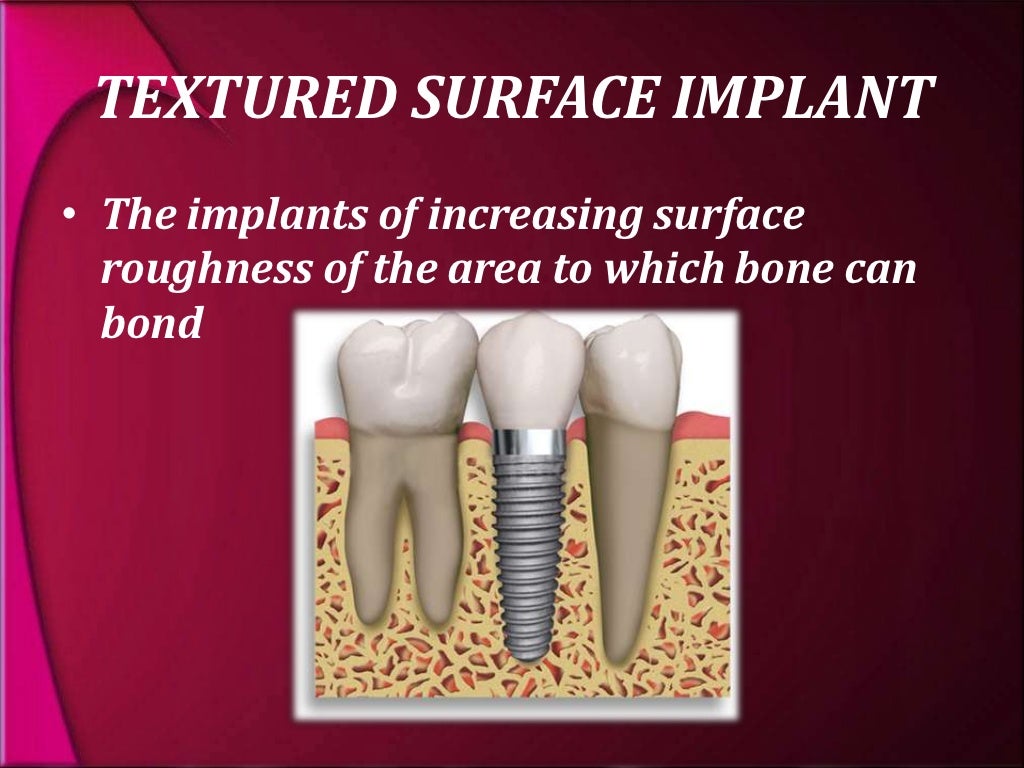 types and classification of dental implants