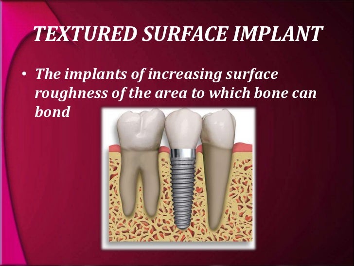 types and classification of dental implants