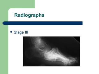 Radiographs
 Stage III
 