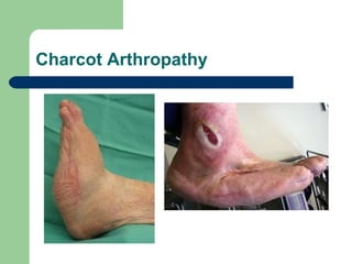 Charcot Arthropathy
 