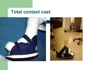 Total contact cast
 