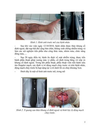 Hình 1: Hình ảnh trước mổ của bệnh nhân
-     Sau khi vào viện ngày 12/10/2010, bệnh nhân được tháo khung cố
định ngoài, đặt nẹp bột đùi cẳng bàn chân, kháng sinh chống nhiễm trùng và
làm các xét nghiệm tiền phẫu như công thức máu, nhóm máu, chức năng
đông máu, ...
-    Sau 20 ngày điều trị, bệnh ổn định về mặt nhiễm trùng, được tiến
hành phẫu thuật ghép xương mác vi phẫu, cố định trong bằng vít xốp và
khung cố định ngoài. Trong khi phẫu thuật, phẫu thuật viên tiến hành siêu
âm Doppler mạch, xác định vị trí động mạch chày trước và trên bệnh nhân,
động mạch chày trước bị hẹp nặng tại vị trí dưới lồi củ chày khoảng 5cm.
-       Dưới đây là một số hình ảnh trước mổ, trong mổ




    Hình 2: X quang sau tháo khung cố định ngoài và hình bộc lộ động mạch
                                 chày trước.



                                                                            2
 