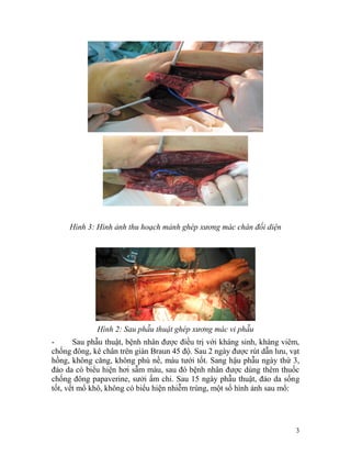 Hình 3: Hình ảnh thu hoạch mảnh ghép xương mác chân đối diện




             Hình 2: Sau phẫu thuật ghép xương mác vi phẫu
-      Sau phẫu thuật, bệnh nhân được điều trị với kháng sinh, kháng viêm,
chống đông, kê chân trên giàn Braun 45 độ. Sau 2 ngày được rút dẫn lưu, vạt
hồng, không căng, không phù nề, máu tưới tốt. Sang hậu phẫu ngày thứ 3,
đảo da có biểu hiện hơi sẫm màu, sau đó bệnh nhân được dùng thêm thuốc
chống đông papaverine, sưởi ấm chi. Sau 15 ngày phẫu thuật, đảo da sống
tốt, vết mổ khô, không có biểu hiện nhiễm trùng, một số hình ảnh sau mổ:




                                                                         3
 