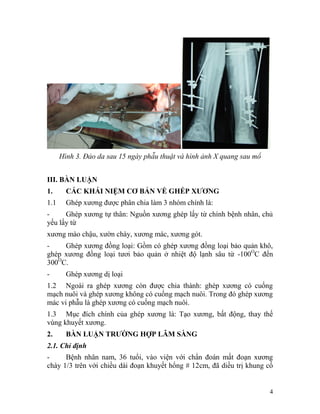 Hình 3. Đảo da sau 15 ngày phẫu thuật và hình ảnh X quang sau mổ


III. BÀN LUẬN
1.      CÁC KHÁI NIỆM CƠ BẢN VỀ GHÉP XƯƠNG
1.1     Ghép xương được phân chia làm 3 nhóm chính là:
-     Ghép xương tự thân: Nguồn xương ghép lấy từ chính bệnh nhân, chủ
yếu lấy từ
xương mào chậu, xườn chày, xương mác, xương gót.
-    Ghép xương đồng loại: Gồm có ghép xương đồng loại bảo quản khô,
ghép xương đồng loại tươi bảo quản ở nhiệt độ lạnh sâu từ -100OC đến
300OC.
-       Ghép xương dị loại
1.2 Ngoài ra ghép xương còn được chia thành: ghép xương có cuống
mạch nuôi và ghép xương không có cuống mạch nuôi. Trong đó ghép xương
mác vi phẫu là ghép xương có cuống mạch nuôi.
1.3 Mục đích chính của ghép xương là: Tạo xương, bất động, thay thế
vùng khuyết xương.
2.      BÀN LUẬN TRƯỜNG HỢP LÂM SÀNG
2.1. Chỉ định
-     Bệnh nhân nam, 36 tuổi, vào viện với chẩn đoán mất đoạn xương
chày 1/3 trên với chiều dài đoạn khuyết hổng # 12cm, đã diều trị khung cố


                                                                         4
 