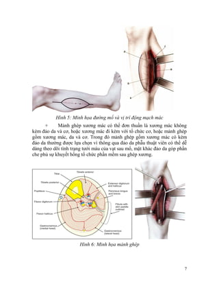 Hình 5: Minh họa đường mổ và vị trí động mạch mác
      +     Mảnh ghép xương mác có thể đơn thuần là xương mác không
kèm đảo da và cơ, hoặc xương mác đi kèm với tổ chức cơ, hoặc mảnh ghép
gồm xương mác, da và cơ. Trong đó mảnh ghép gồm xương mác có kèm
đảo da thường được lựa chọn vì thông qua đảo da phẫu thuật viên có thể dễ
dàng theo dõi tình trạng tưới máu của vạt sau mổ, mặt khác đảo da góp phần
che phủ sự khuyết hổng tổ chức phần mềm sau ghép xương.




                      Hinh 6: Minh họa mảnh ghép



                                                                        7
 