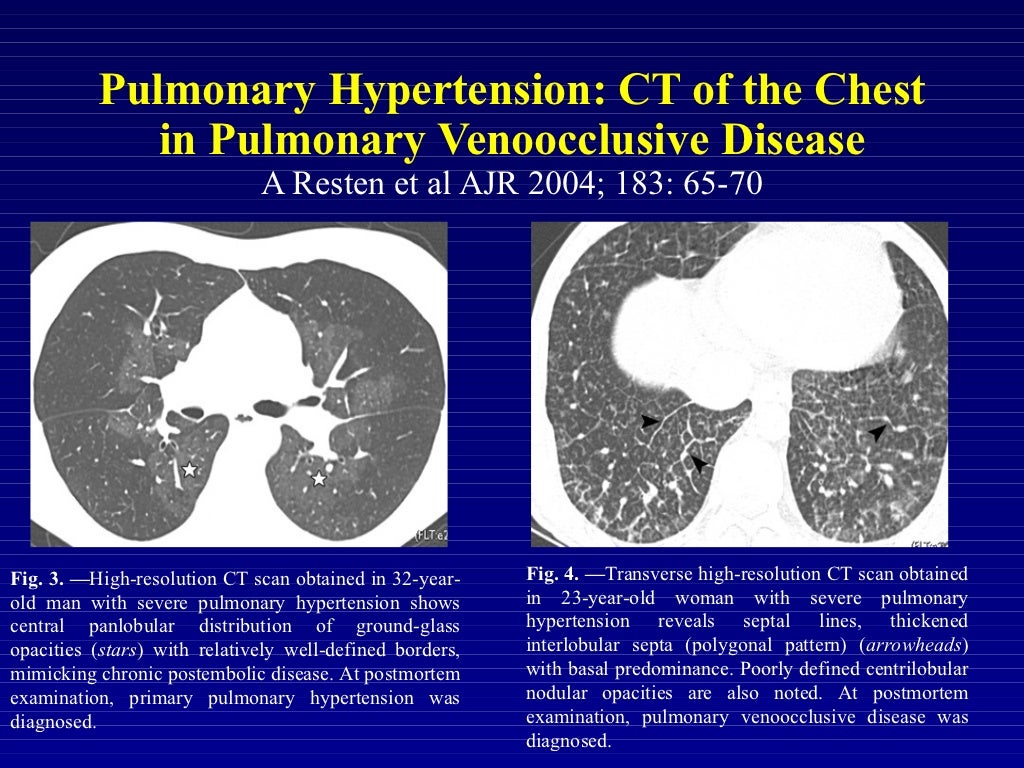 Ipertensione Polmonare: classificazione e linee guida