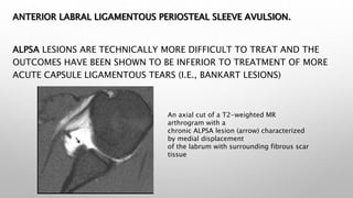 Gleno Humeral Instability - Dr Kiran Srinivas © | PPTX