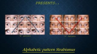 PRESENTS..
Alphabetic pattern Strabismus
‘A’ pattern ‘V’ Pattern
 