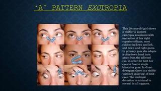 Ghostdogg productions present ~ alphabet pattern strabismus online ...