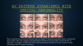 Ghostdogg productions present ~ alphabet pattern strabismus online ...