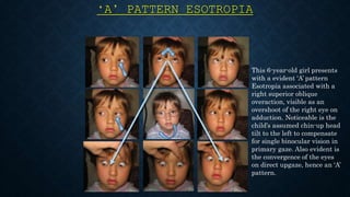 Ghostdogg productions present ~ alphabet pattern strabismus online ...