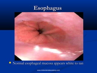 Esophagus



Normal esophageal mucosa appears white to tan
www.indiandentalacademy.com

 