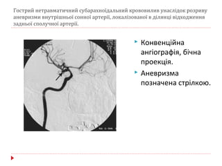 Гострий нетравматичний субарахноїдальний крововилив унаслідок розриву
аневризми внутрішньої сонної артерії, локалізованої в ділянці відходження
задньої сполучної артерії.
 Конвенційна
ангіографія, бічна
проекція.
 Аневризма
позначена стрілкою.
 