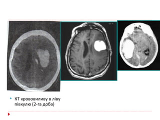 КТ крововиливу в ліву
півкулю (2-га доба)
 