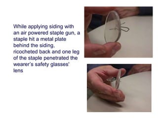 While applying siding with 
an air powered staple gun, a 
staple hit a metal plate 
behind the siding, 
ricocheted back and one leg 
of the staple penetrated the 
wearer’s safety glasses' 
lens 
 