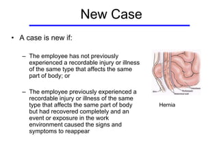 New Case
• A case is new if:
– The employee has not previously
experienced a recordable injury or illness
of the same type that affects the same
part of body; or
– The employee previously experienced a
recordable injury or illness of the same
type that affects the same part of body
but had recovered completely and an
event or exposure in the work
environment caused the signs and
symptoms to reappear
Hernia
 