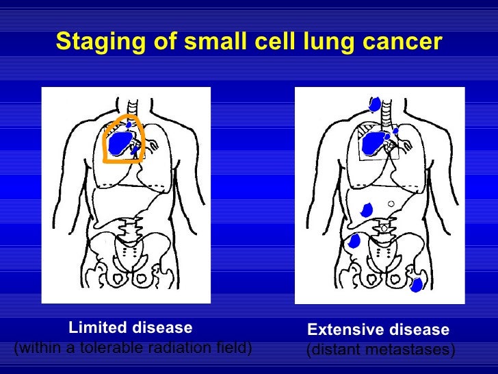 Why Is Small Cell Lung Cancer Inoperable SMALL CELL LUNG CANCER (SCLC)