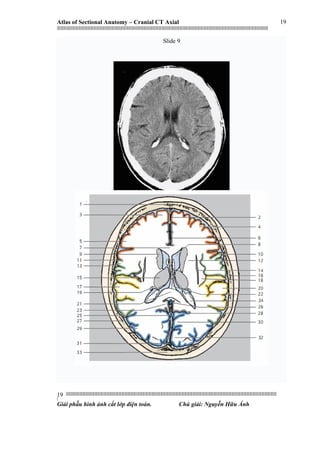 Atlas of Sectional Anatomy – Cranial CT Axial
|||||||||||||||||||||||||||||||||||||||||||||||||||||||||||||||||||||||||||||||||||||||||||||||||||||||||||||||||||||||||||||||||||||||||||||||||||||||||||||||||||||||||||||||||||||||||||||||||||||||||||||||||||||||||||||||||||||||||||||||||||||||||||||||||||||
||||||||||||||||||||||||||||||||||||||||||||||||||||||||||||||||||||||||||||||||||||||||||||||||||||||||||||||||||||||||||||||||||||||||||||||||||||||||||||||||||||||||||||||||||||||||||||||||||||||||||||||||||||||||||||||||||||||||||||||||||||||||||||||||||||
|
Giải phẫu hình ảnh cắt lớp điện toán. Chú giải: Nguyễn Hữu Ánh
19
19
Slide 9
 