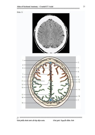 Atlas of Sectional Anatomy – Cranial CT Axial
|||||||||||||||||||||||||||||||||||||||||||||||||||||||||||||||||||||||||||||||||||||||||||||||||||||||||||||||||||||||||||||||||||||||||||||||||||||||||||||||||||||||||||||||||||||||||||||||||||||||||||||||||||||||||||||||||||||||||||||||||||||||||||||||||||||
||||||||||||||||||||||||||||||||||||||||||||||||||||||||||||||||||||||||||||||||||||||||||||||||||||||||||||||||||||||||||||||||||||||||||||||||||||||||||||||||||||||||||||||||||||||||||||||||||||||||||||||||||||||||||||||||||||||||||||||||||||||||||||||||||||
|
Giải phẫu hình ảnh cắt lớp điện toán. Chú giải: Nguyễn Hữu Ánh
23
23
Slide 11
 