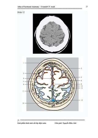 Atlas of Sectional Anatomy – Cranial CT Axial
|||||||||||||||||||||||||||||||||||||||||||||||||||||||||||||||||||||||||||||||||||||||||||||||||||||||||||||||||||||||||||||||||||||||||||||||||||||||||||||||||||||||||||||||||||||||||||||||||||||||||||||||||||||||||||||||||||||||||||||||||||||||||||||||||||||
||||||||||||||||||||||||||||||||||||||||||||||||||||||||||||||||||||||||||||||||||||||||||||||||||||||||||||||||||||||||||||||||||||||||||||||||||||||||||||||||||||||||||||||||||||||||||||||||||||||||||||||||||||||||||||||||||||||||||||||||||||||||||||||||||||
|
Giải phẫu hình ảnh cắt lớp điện toán. Chú giải: Nguyễn Hữu Ánh
25
25
Slide 12
 