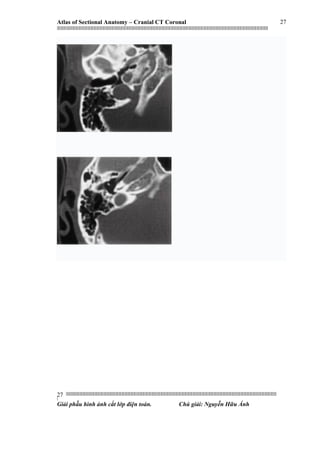 Atlas of Sectional Anatomy – Cranial CT Coronal
|||||||||||||||||||||||||||||||||||||||||||||||||||||||||||||||||||||||||||||||||||||||||||||||||||||||||||||||||||||||||||||||||||||||||||||||||||||||||||||||||||||||||||||||||||||||||||||||||||||||||||||||||||||||||||||||||||||||||||||||||||||||||||||||||||||
||||||||||||||||||||||||||||||||||||||||||||||||||||||||||||||||||||||||||||||||||||||||||||||||||||||||||||||||||||||||||||||||||||||||||||||||||||||||||||||||||||||||||||||||||||||||||||||||||||||||||||||||||||||||||||||||||||||||||||||||||||||||||||||||||||
|
Giải phẫu hình ảnh cắt lớp điện toán. Chú giải: Nguyễn Hữu Ánh
27
27
 