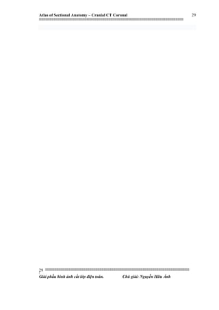 Atlas of Sectional Anatomy – Cranial CT Coronal
|||||||||||||||||||||||||||||||||||||||||||||||||||||||||||||||||||||||||||||||||||||||||||||||||||||||||||||||||||||||||||||||||||||||||||||||||||||||||||||||||||||||||||||||||||||||||||||||||||||||||||||||||||||||||||||||||||||||||||||||||||||||||||||||||||||
||||||||||||||||||||||||||||||||||||||||||||||||||||||||||||||||||||||||||||||||||||||||||||||||||||||||||||||||||||||||||||||||||||||||||||||||||||||||||||||||||||||||||||||||||||||||||||||||||||||||||||||||||||||||||||||||||||||||||||||||||||||||||||||||||||
|
Giải phẫu hình ảnh cắt lớp điện toán. Chú giải: Nguyễn Hữu Ánh
29
29
 
