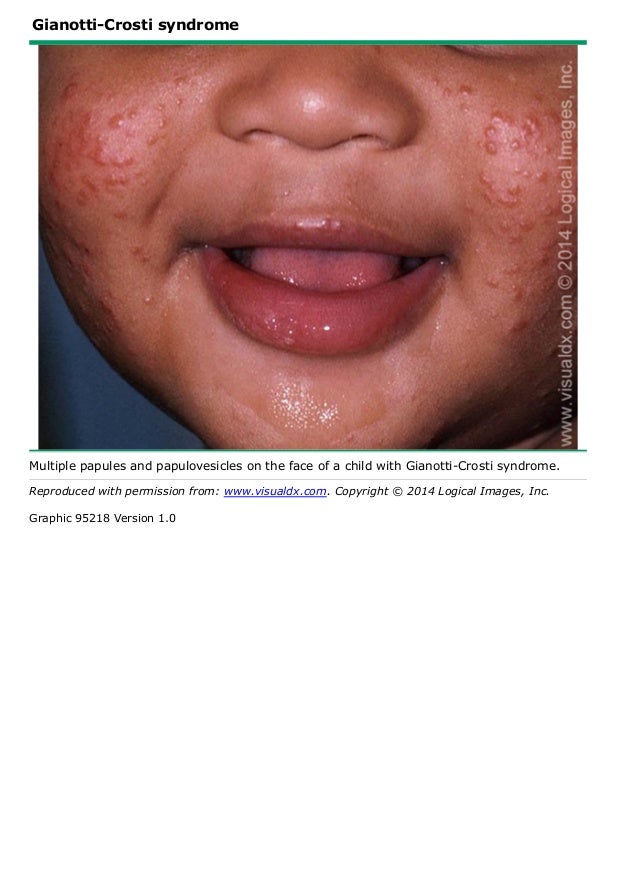 Hand, Foot, and Mouth Disease Center by Hand, Foot, and Mouth Disease Center by