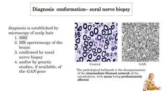 Diagnosis conformation– sural nerve biopsy
The pathological hallmark is the disorganization
of the intermediate filament network of the
cytoskeleton, with axons being predominantly
affected.
Control GAN
diagnosis is established by
microscopy of scalp hair
1. MRI
2. MR spectroscopy of the
brain;
3. confirmed by sural
nerve biopsy
4. and/or by genetic
studies, if available, of
the GAN gene
 