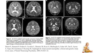 Demir E, Bomont P, Erdem S, Cavalier L, Demirci M, Kose G, Muftuoglu S, Cakar AN, Tan E, Aysun
S, Topcu M, Guicheney P, Koenig M, Topaloglu H. Giant axonal neuropathy: clinical and genetic study
in six cases. J Neurol Neurosurg Psychiatry. 2005;76:825–32.
 