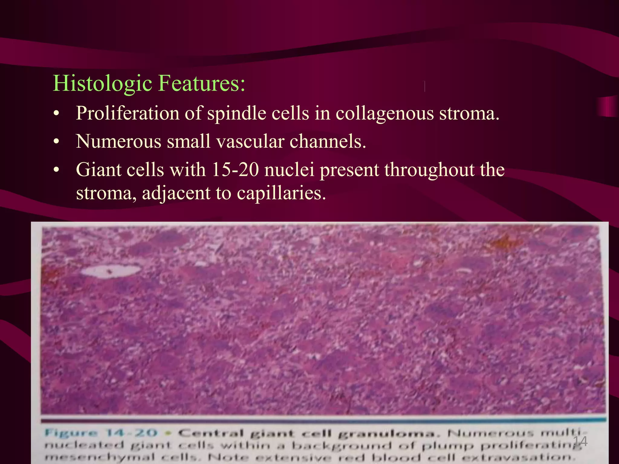 Giant cell lesions of the jaws | PPTX